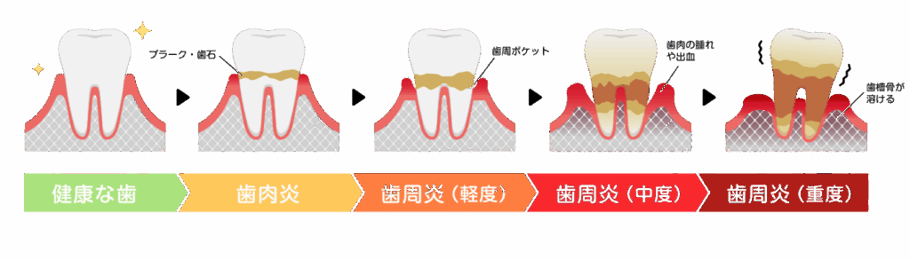 歯周病の進行|中西歯科