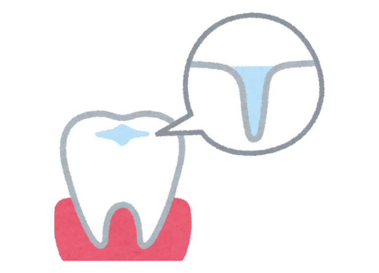 シーラント|中西歯科