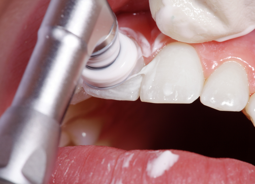 ポリッシングペースト|中西歯科