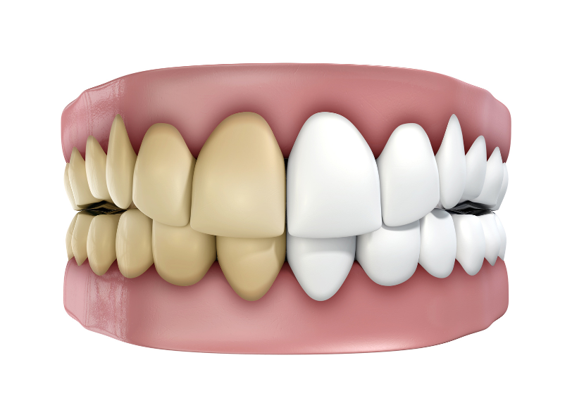 なぜ歯の色が変わるのか|中西歯科