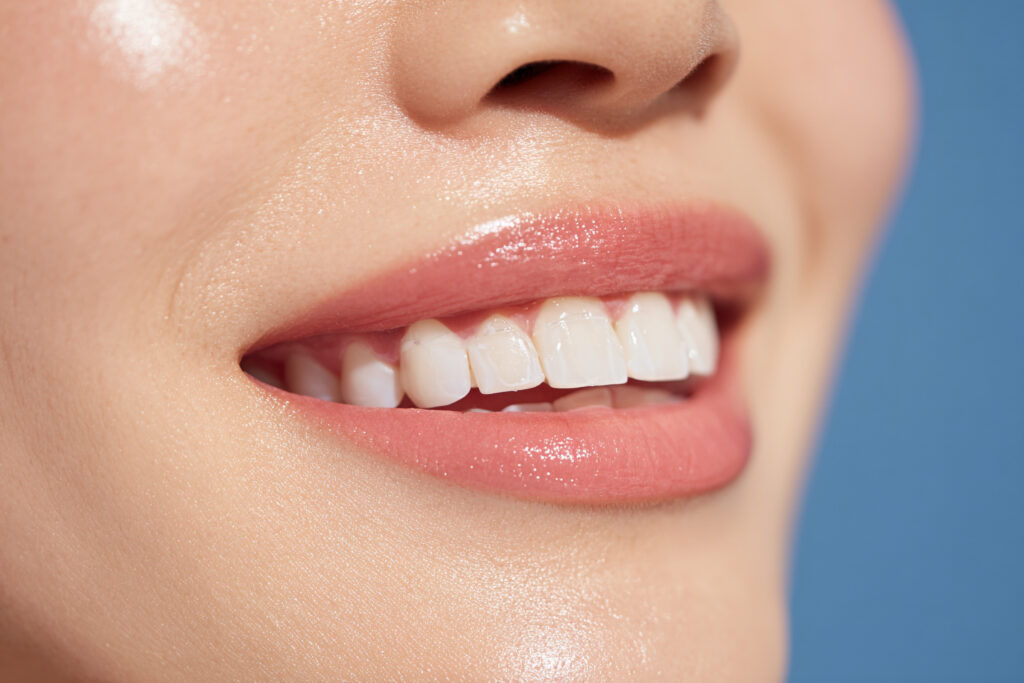 ホワイトニングして綺麗になった女性の歯