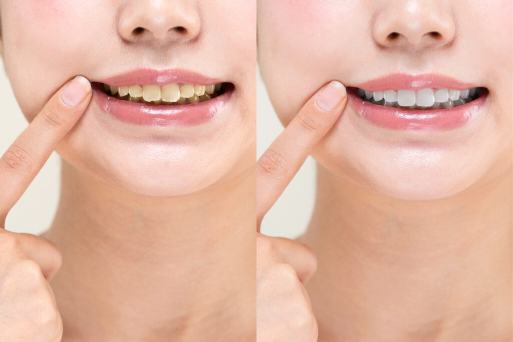 そのままの歯とホワイトニングした歯の比較