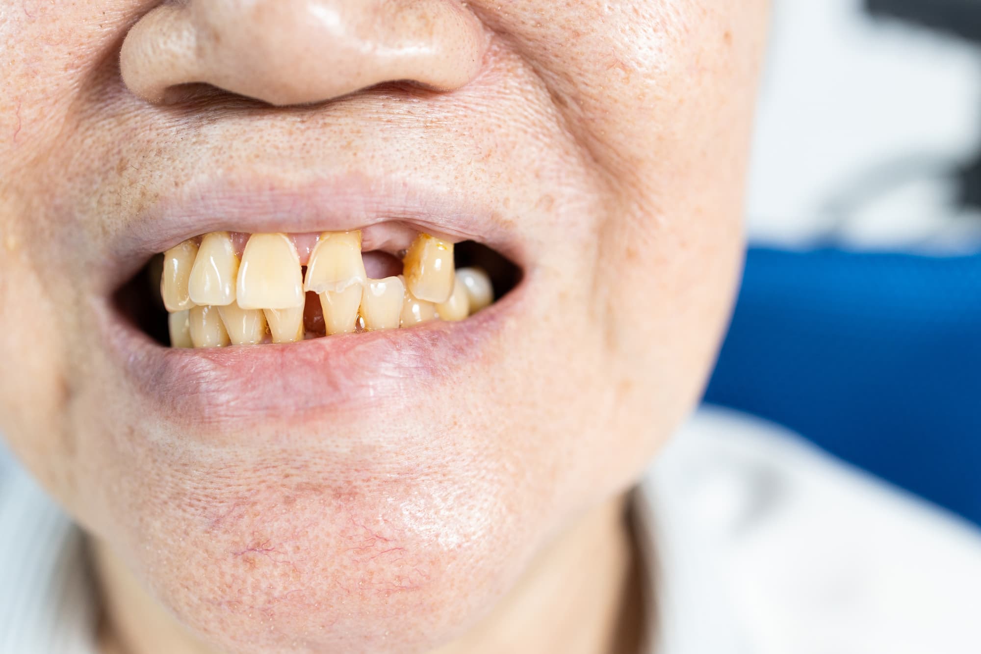 何本か歯が抜けた人の口元