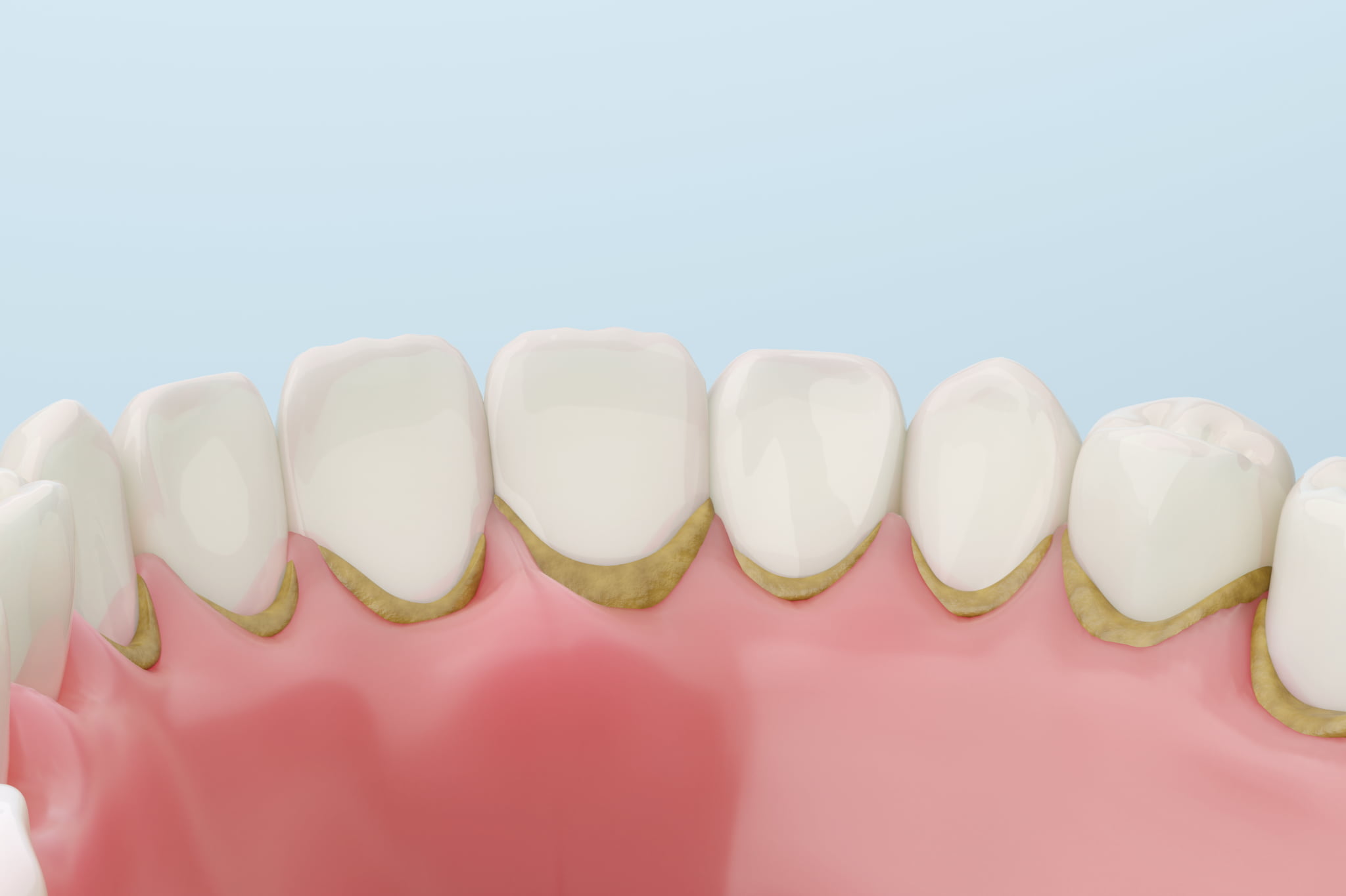 プラークが蓄積した口腔内のイメージ