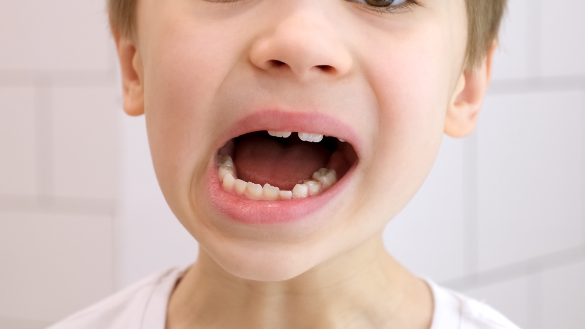 すきっ歯で受け口の子どもの口元